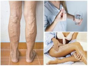 Venas varicosas en las piernas y métodos de tratamiento